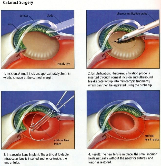 Cataract Surgey Process