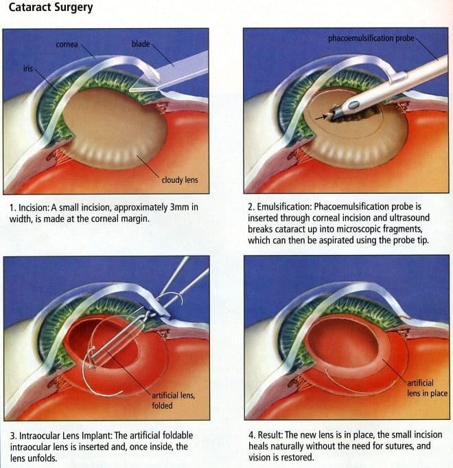 Cataract Surgery Concord Eye Center 