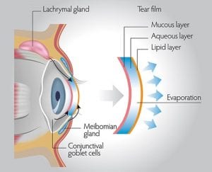 Dry Eye Diagram