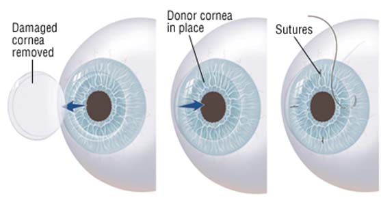 Corneal K