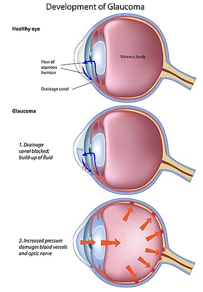 The Amazing Eye: The Mechanics Of Vision - Glaucoma Research